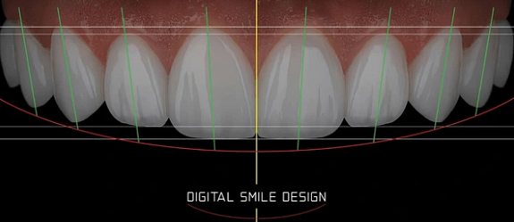 fatetele-dentare-ce-sunt-zambet-frumos-3.png